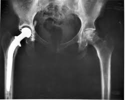 An anteroposterior (A-P) X-ray of a pelvis showing a total hip joint replacement